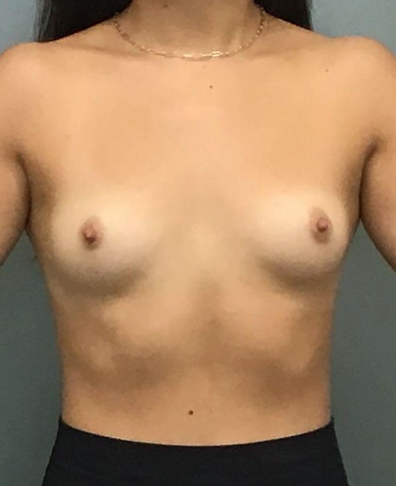 Breast Augmentation Before & After Gallery - Patient 877931 - Image 1