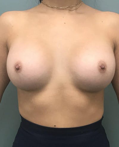 Breast Augmentation Before & After Gallery - Patient 877931 - Image 2