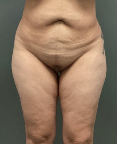 Thigh Lift Before & After Gallery - Patient 139053 - Image 1