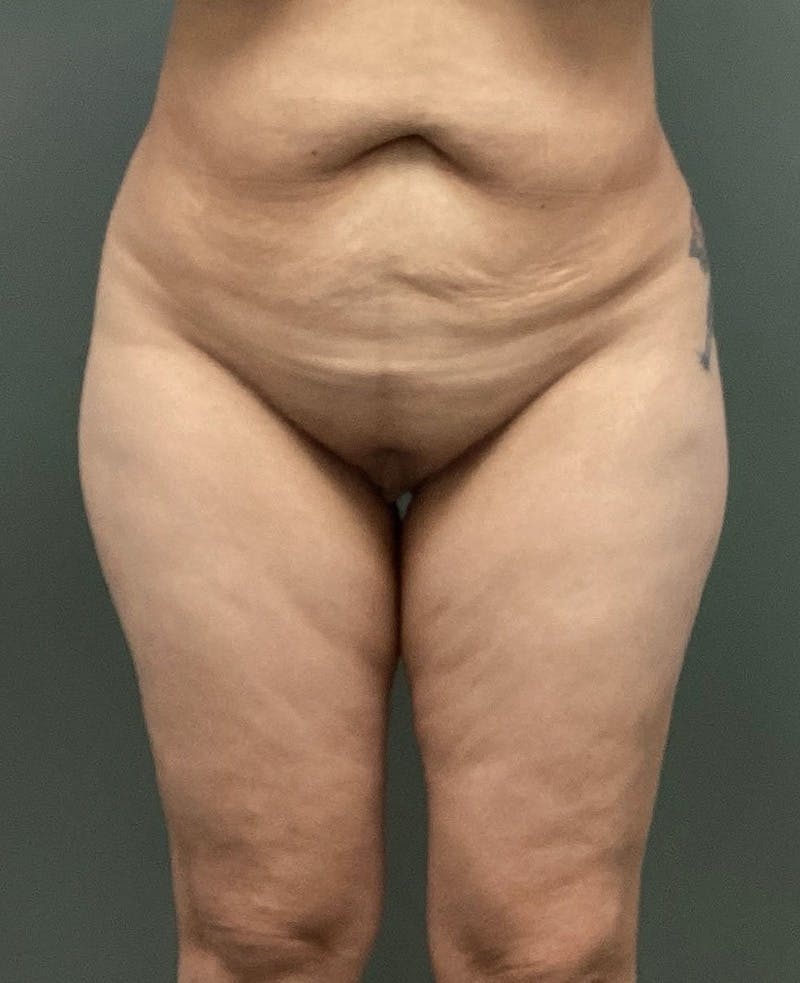 Thigh Lift Before & After Gallery - Patient 139053 - Image 1