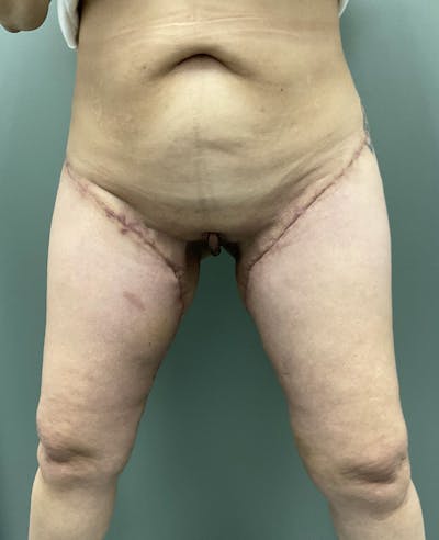 Thigh Lift Before & After Gallery - Patient 139053 - Image 2