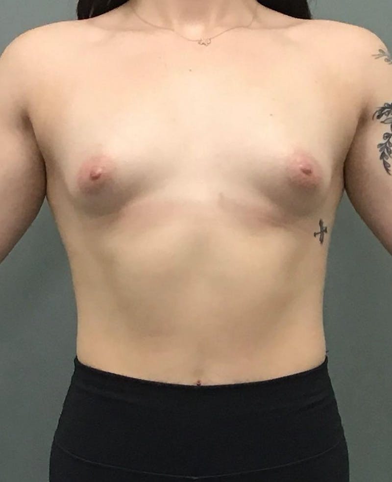 Breast Augmentation Before & After Gallery - Patient 375680 - Image 1