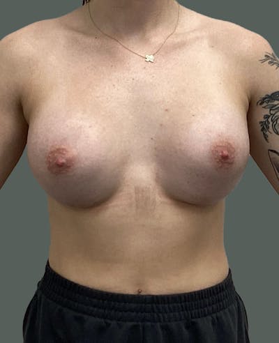 Breast Augmentation Before & After Gallery - Patient 375680 - Image 2