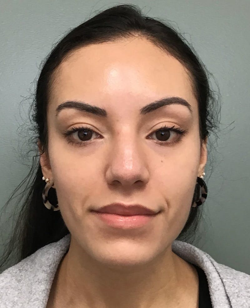 Rhinoplasty Before & After Gallery - Patient 401105 - Image 1