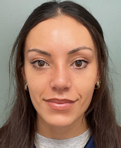 Rhinoplasty Before & After Gallery - Patient 401105 - Image 2