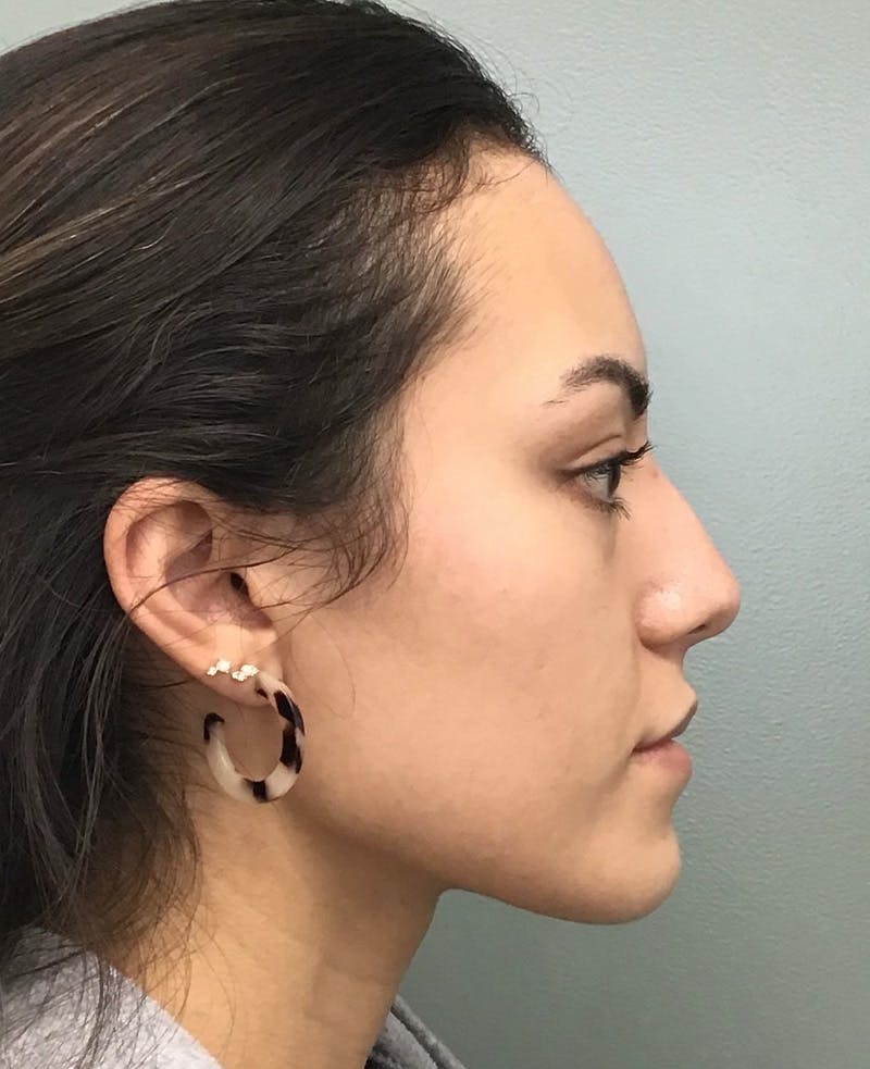 Rhinoplasty Before & After Gallery - Patient 401105 - Image 3