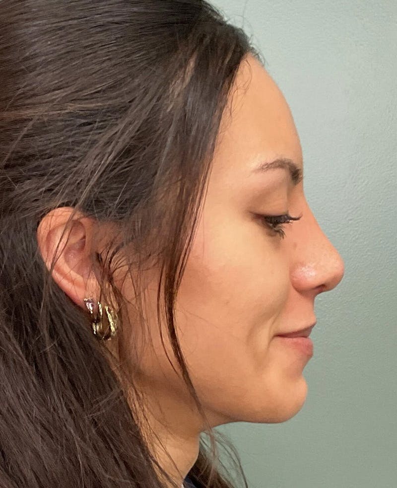 Rhinoplasty Before & After Gallery - Patient 401105 - Image 4