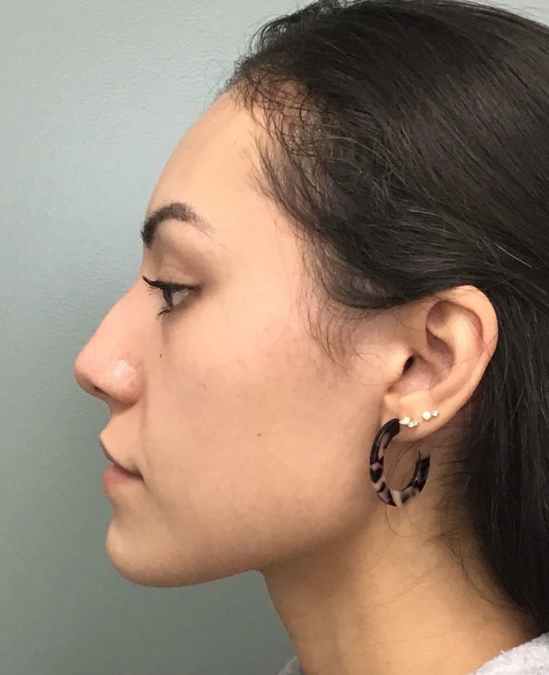 Rhinoplasty Before & After Gallery - Patient 401105 - Image 5