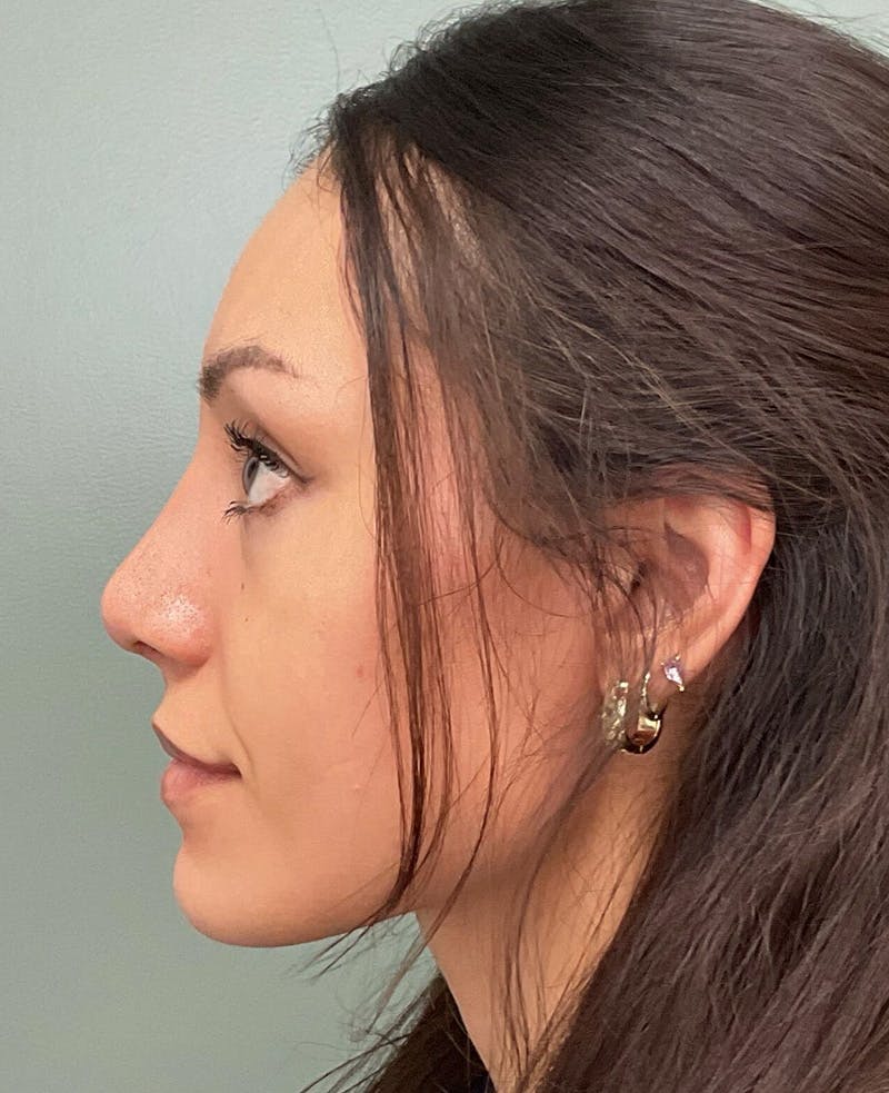 Rhinoplasty Before & After Gallery - Patient 401105 - Image 6