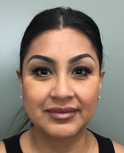 Rhinoplasty Before & After Gallery - Patient 134412 - Image 1