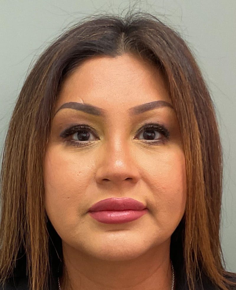 Rhinoplasty Before & After Gallery - Patient 134412 - Image 2