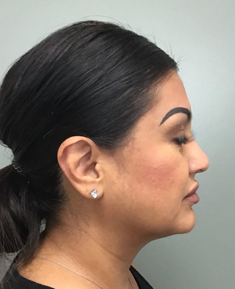 Rhinoplasty Before & After Gallery - Patient 134412 - Image 3