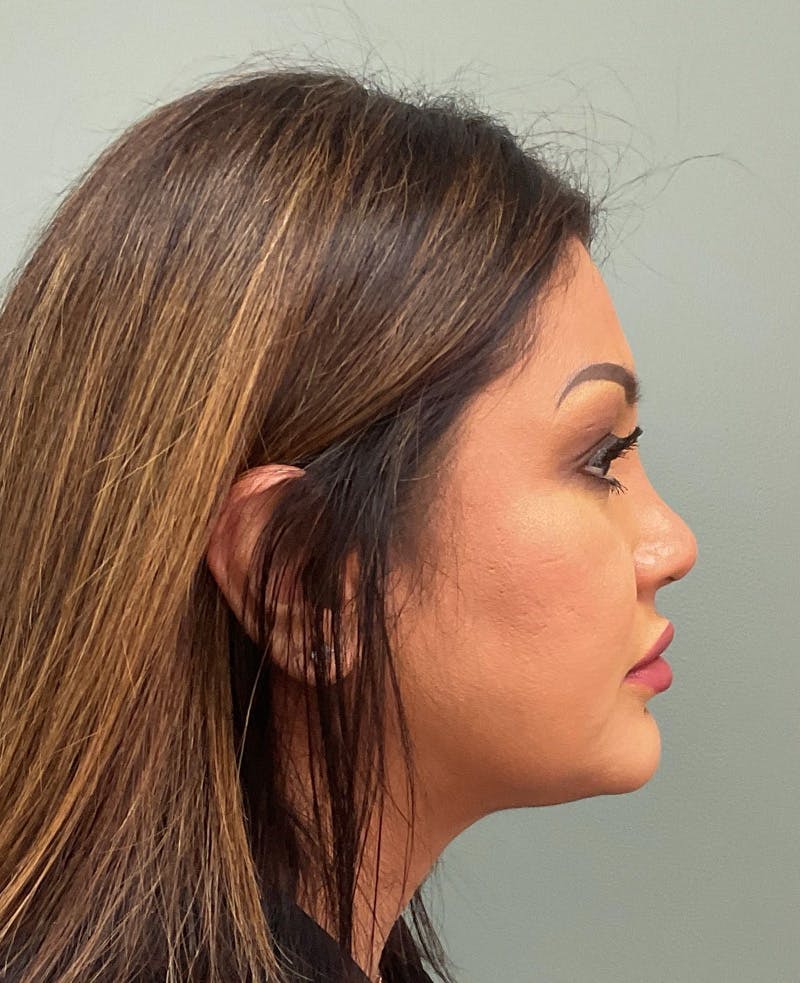 Rhinoplasty Before & After Gallery - Patient 134412 - Image 4