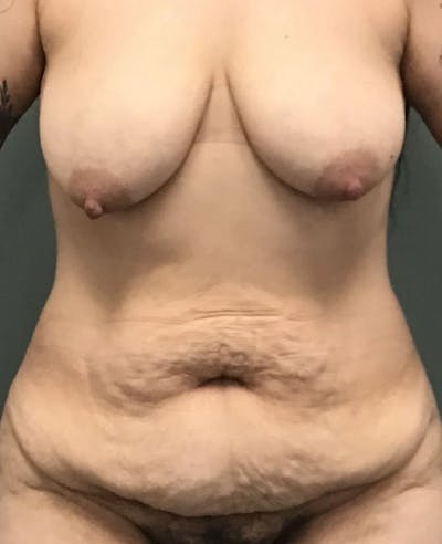Tummy Tuck Before & After Gallery - Patient 409347 - Image 1