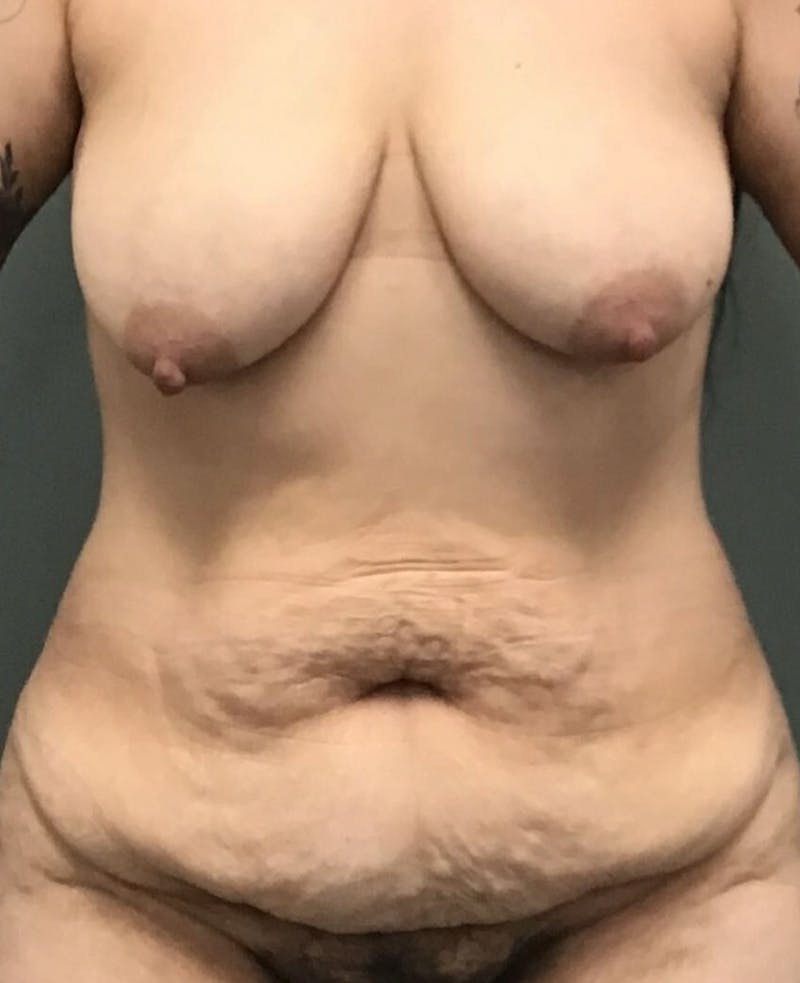 Tummy Tuck Before & After Gallery - Patient 409347 - Image 1
