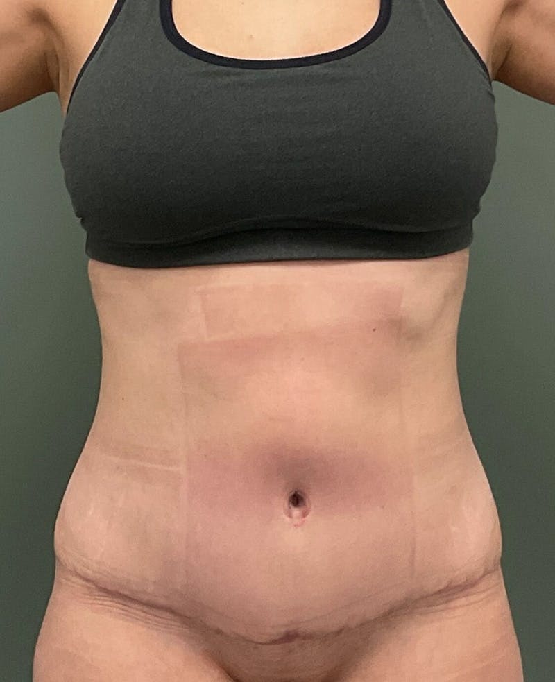 Tummy Tuck Before & After Gallery - Patient 191929 - Image 2