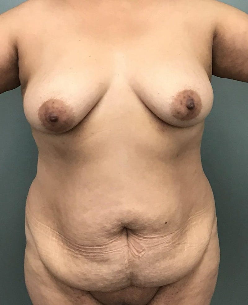 Tummy Tuck Before & After Gallery - Patient 111838 - Image 1