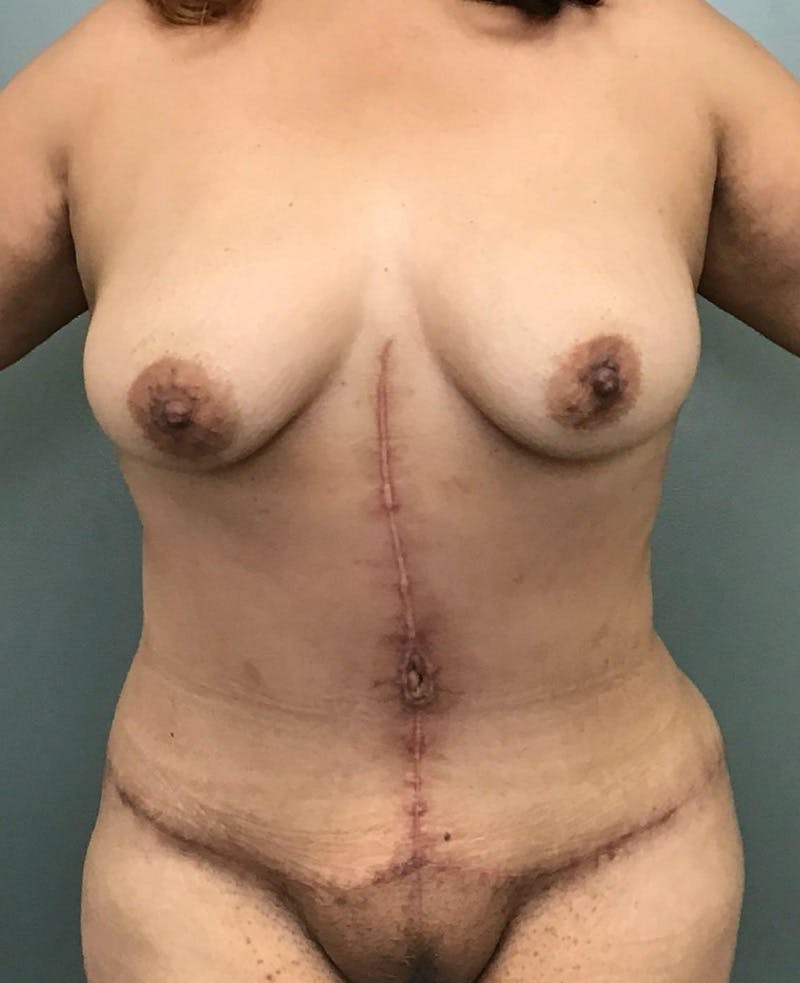 Tummy Tuck Before & After Gallery - Patient 111838 - Image 2