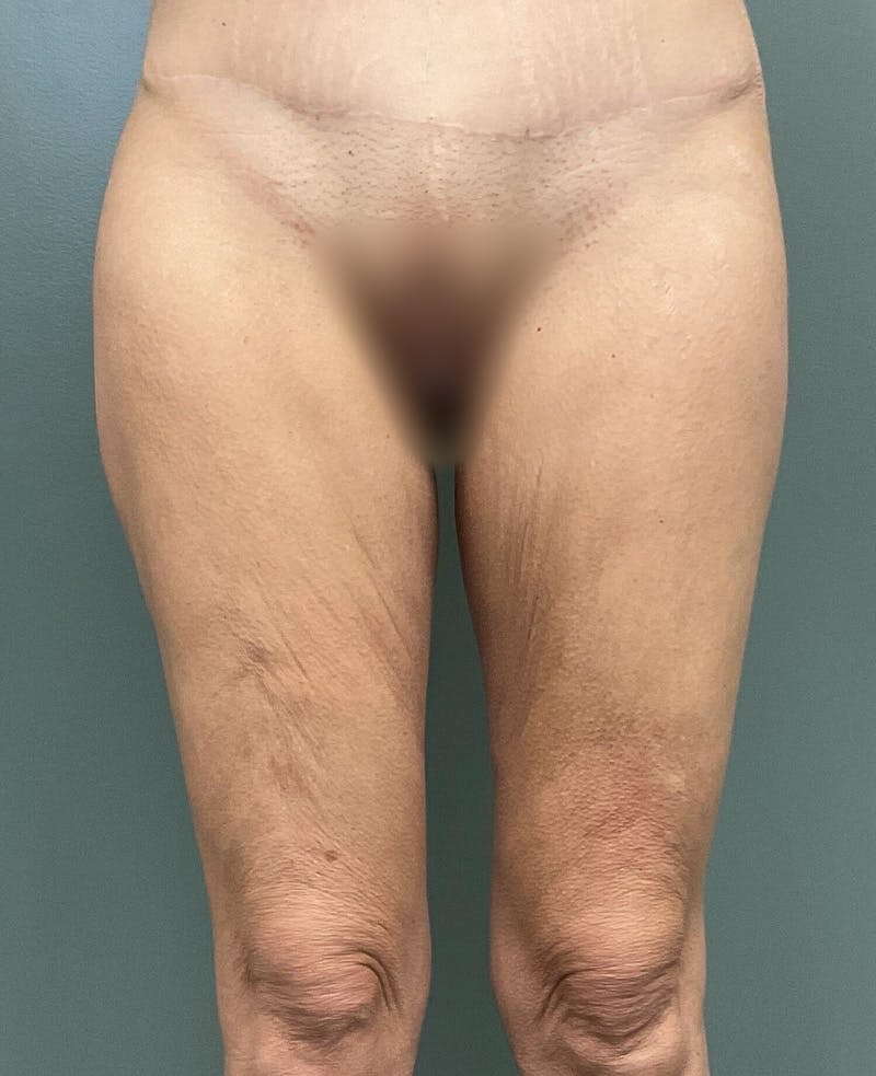 Thigh Lift Before & After Gallery - Patient 799771 - Image 1