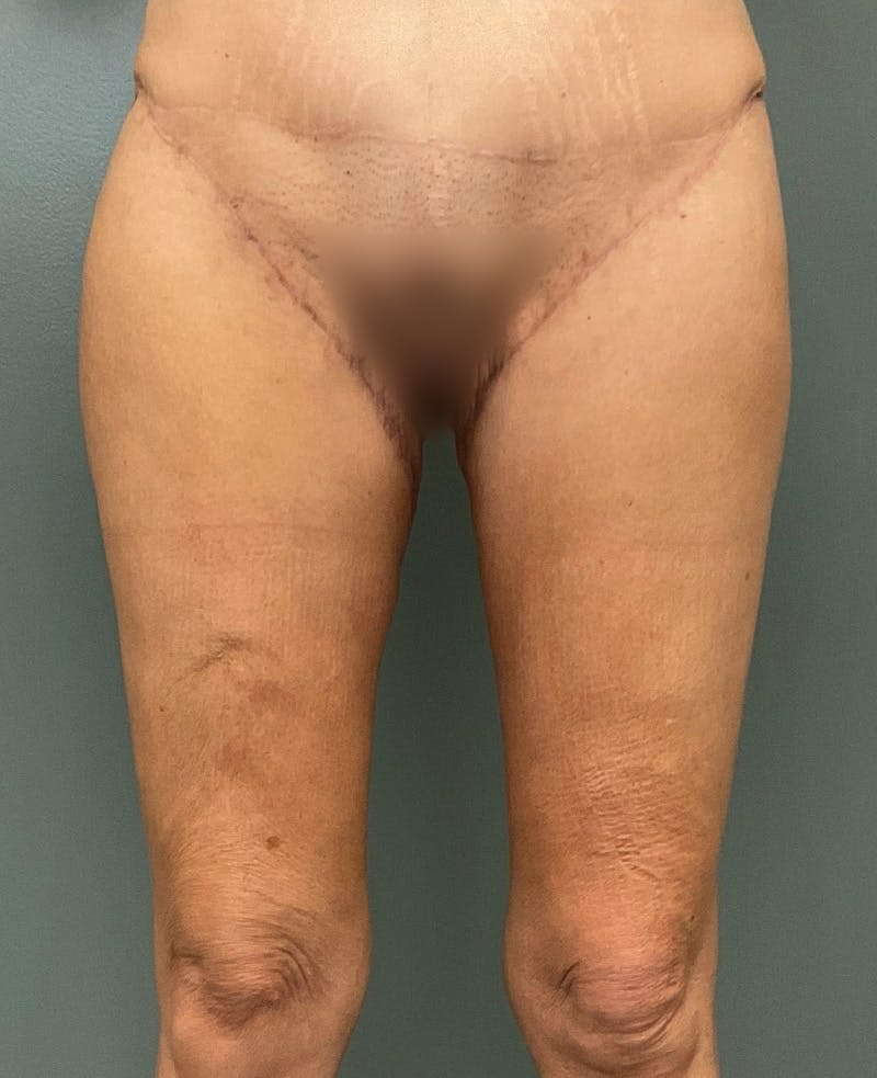 Thigh Lift Before & After Gallery - Patient 799771 - Image 2