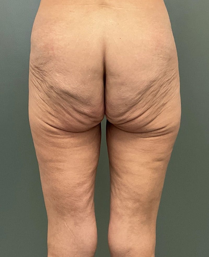 Thigh Lift Before & After Gallery - Patient 799771 - Image 3