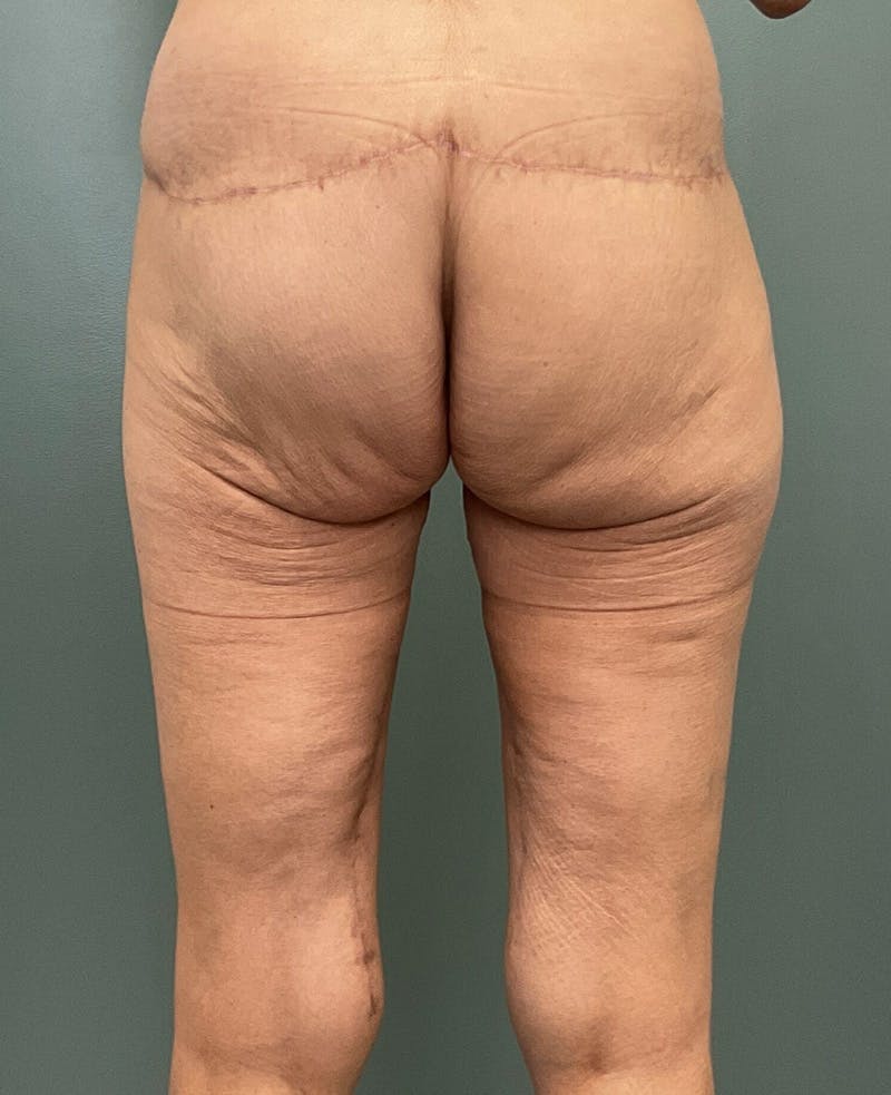 Thigh Lift Before & After Gallery - Patient 799771 - Image 4