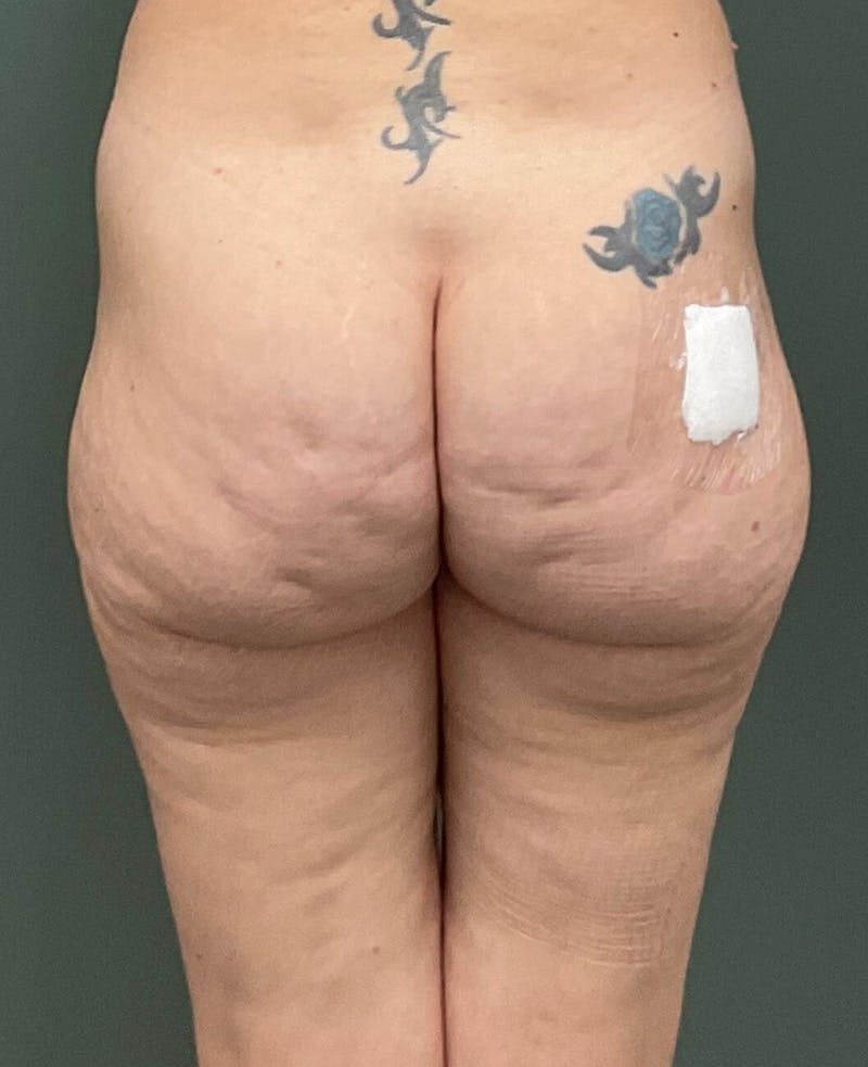 Brazilian Butt Lift Before & After Gallery - Patient 273381 - Image 1