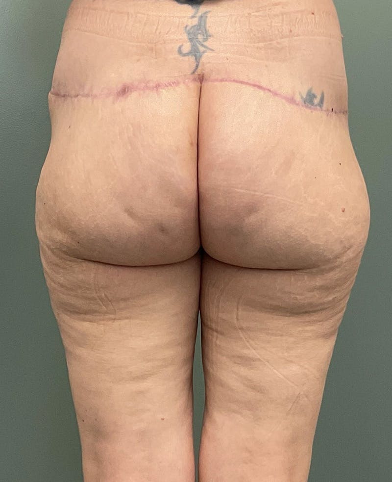 Brazilian Butt Lift Before & After Gallery - Patient 273381 - Image 2