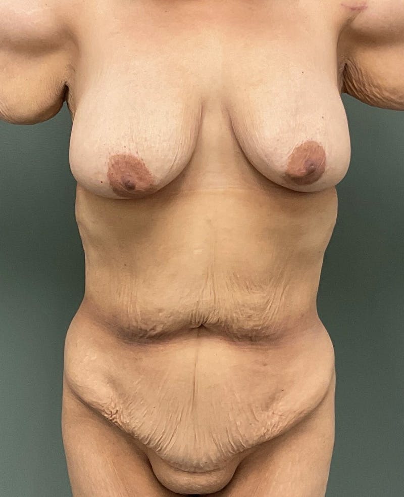 Breast Augmentation Before & After Gallery - Patient 363937 - Image 1