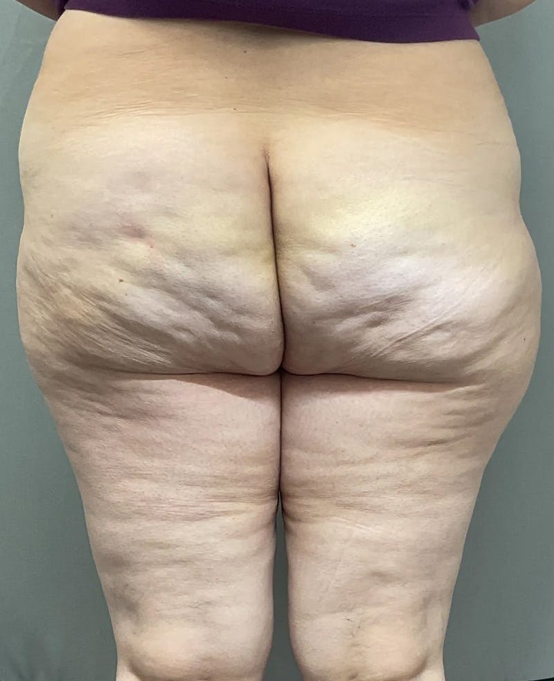 Avéli Cellulite Treatment Before & After Gallery - Patient 960332 - Image 1