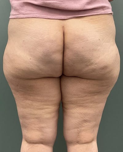 Avéli Cellulite Treatment Before & After Gallery - Patient 960332 - Image 2