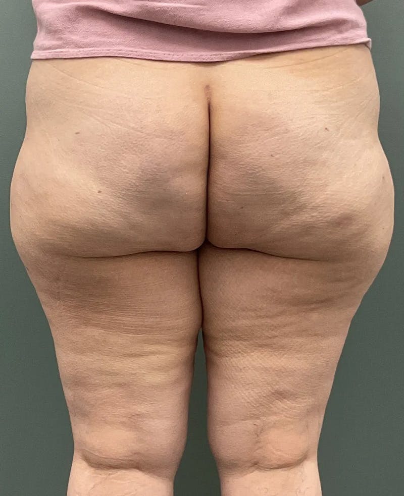 Avéli Cellulite Treatment Before & After Gallery - Patient 960332 - Image 2