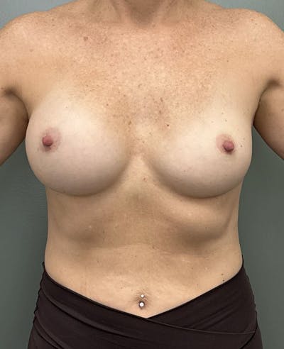 Breast Implant Removal Before & After Gallery - Patient 958326 - Image 1
