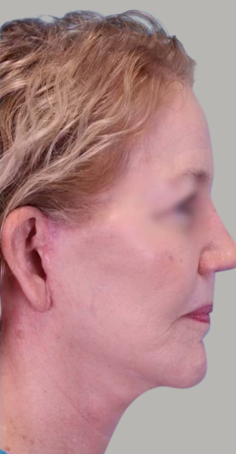 Facelift Before & After Gallery - Patient 946665 - Image 4