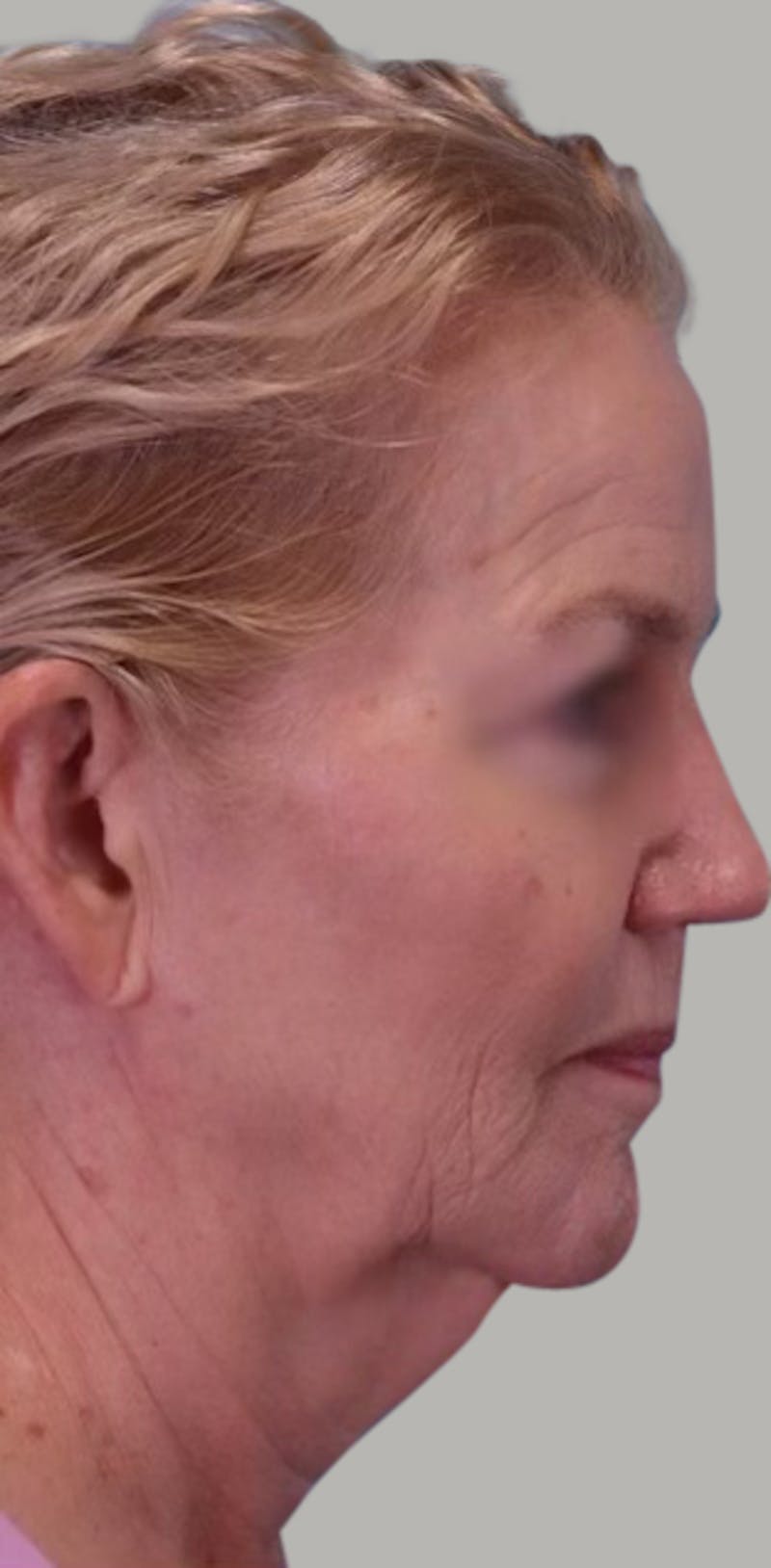 Facelift Before & After Gallery - Patient 946665 - Image 3