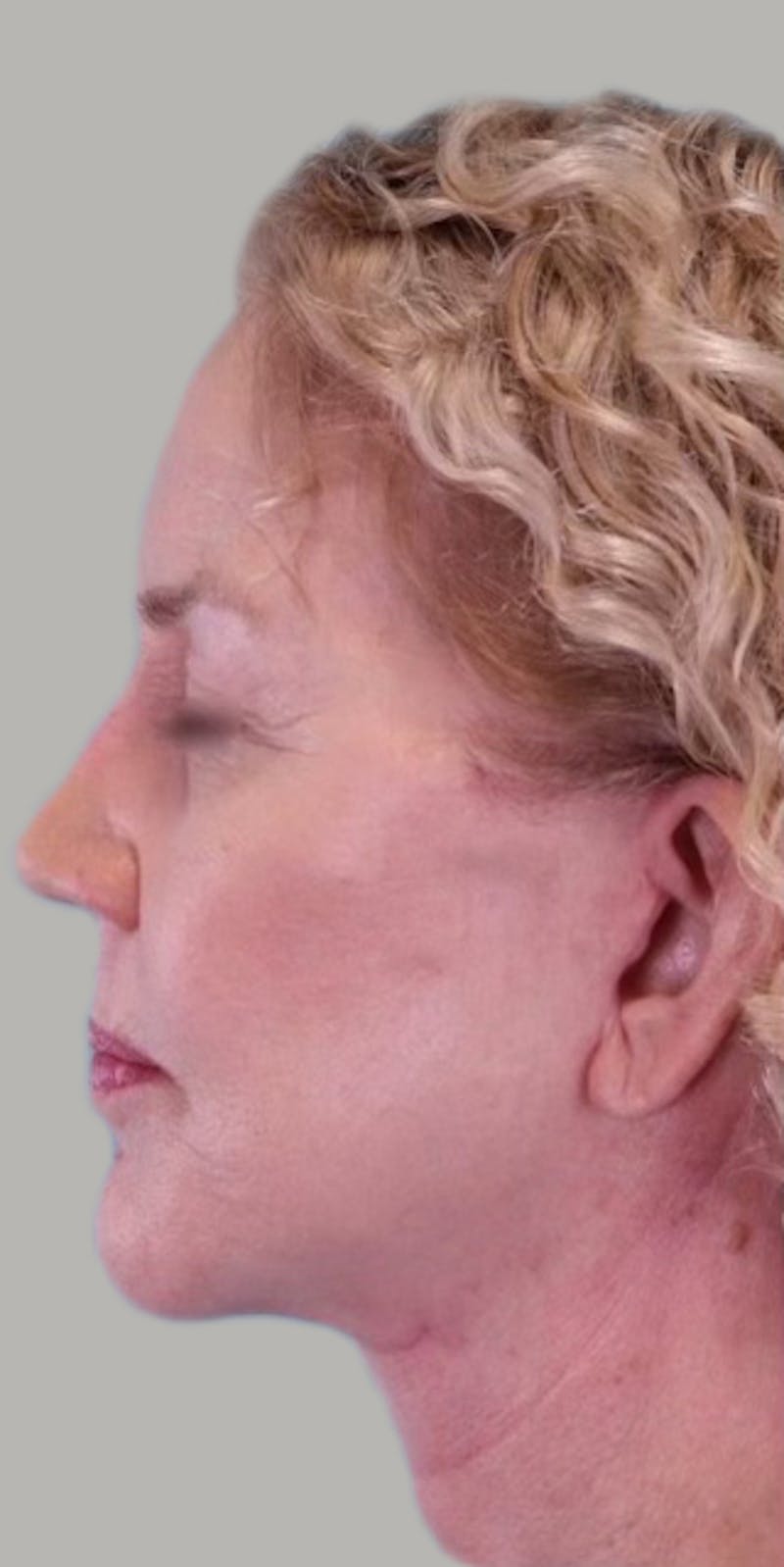 Facelift Before & After Gallery - Patient 946665 - Image 6