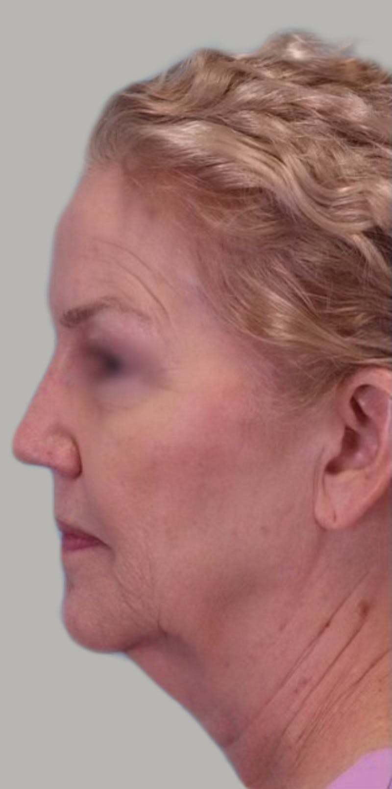 Facelift Before & After Gallery - Patient 946665 - Image 5