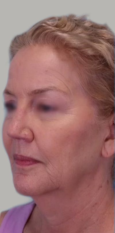Neck Lift Before & After Gallery - Patient 351315 - Image 1