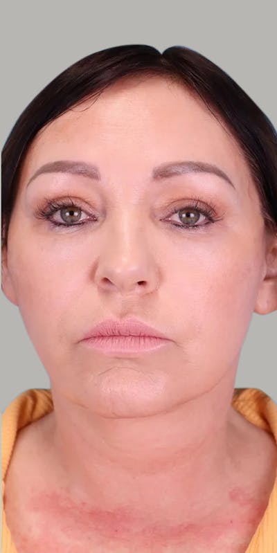 Neck Lift Before & After Gallery - Patient 145705 - Image 2