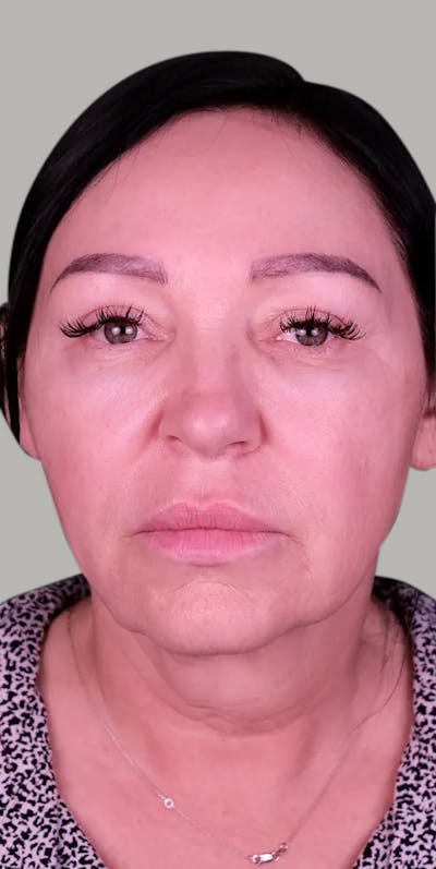 Neck Lift Before & After Gallery - Patient 145705 - Image 1