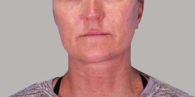 Facelift Before & After Gallery - Patient 376941 - Image 2