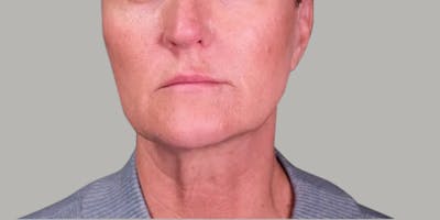 Neck Lift Before & After Gallery - Patient 321204 - Image 1
