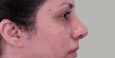 Rhinoplasty Before & After Gallery - Patient 296498 - Image 2
