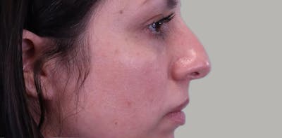 Rhinoplasty Before & After Gallery - Patient 296498 - Image 1