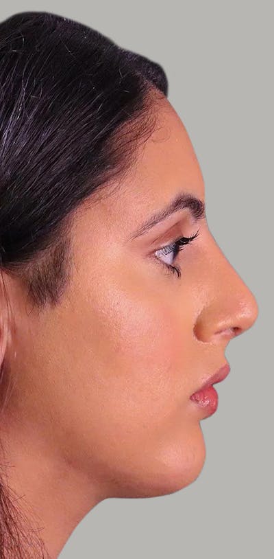 Rhinoplasty Before & After Gallery - Patient 372855 - Image 2