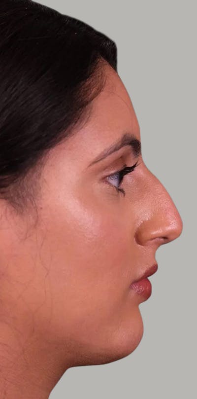 Rhinoplasty Before & After Gallery - Patient 372855 - Image 1