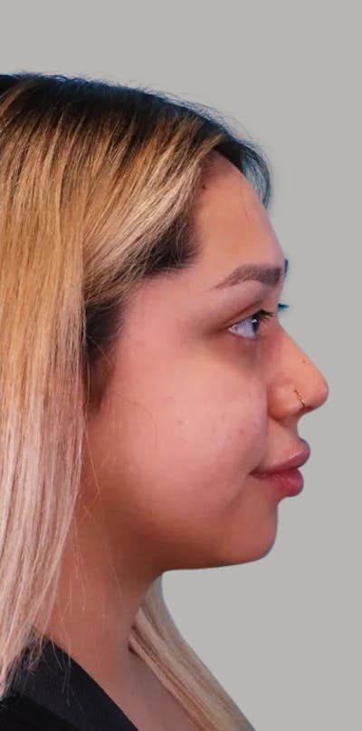 Rhinoplasty Before & After Gallery - Patient 263641 - Image 2