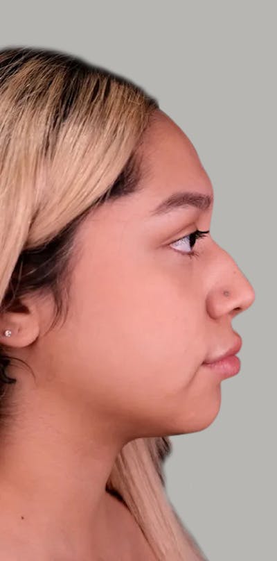 Rhinoplasty Before & After Gallery - Patient 263641 - Image 1