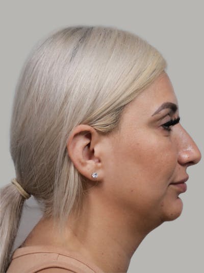 Rhinoplasty Before & After Gallery - Patient 341488 - Image 1
