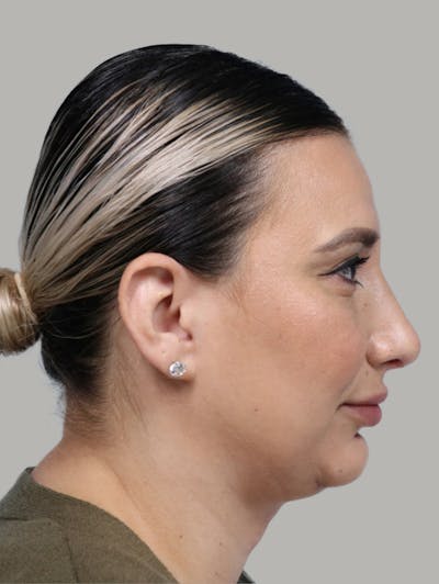 Rhinoplasty Before & After Gallery - Patient 341488 - Image 2